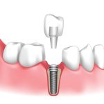 Tìm hiểu về kỹ thuật phục hình răng sứ trên Implant