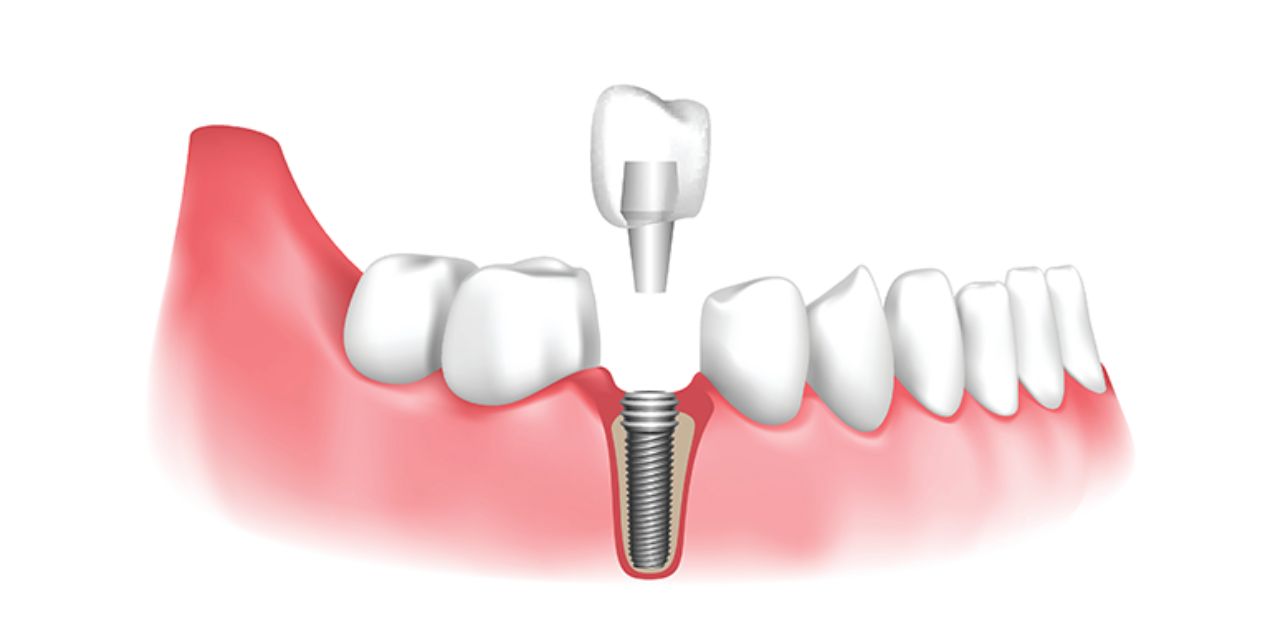 Quy trình hỗ trợ khi dùng răng sứ trên implant trong trường hợp hàm răng bị mất nhiều răng?
