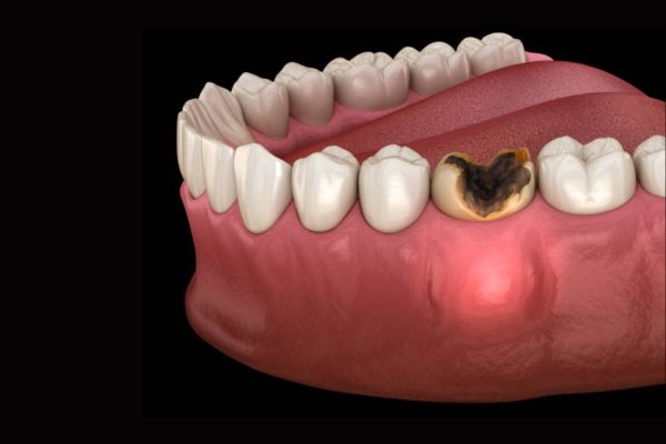 Răng bị viêm tủy nếu không được điều trị có thể dẫn tới mất răng và các biến chứng nguy hiểm