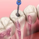 Phương pháp điều trị tủy răng tại nha khoa hiện nay