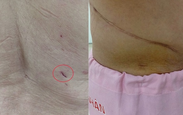 Kỹ thuật tán sỏi qua da để lại sẹo nhỏ hơn rất nhiều so với phương pháp mổ thông thường