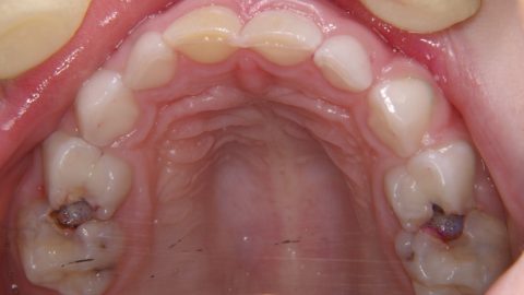 Chuyên gia giải đáp: Sâu răng có lây không?
