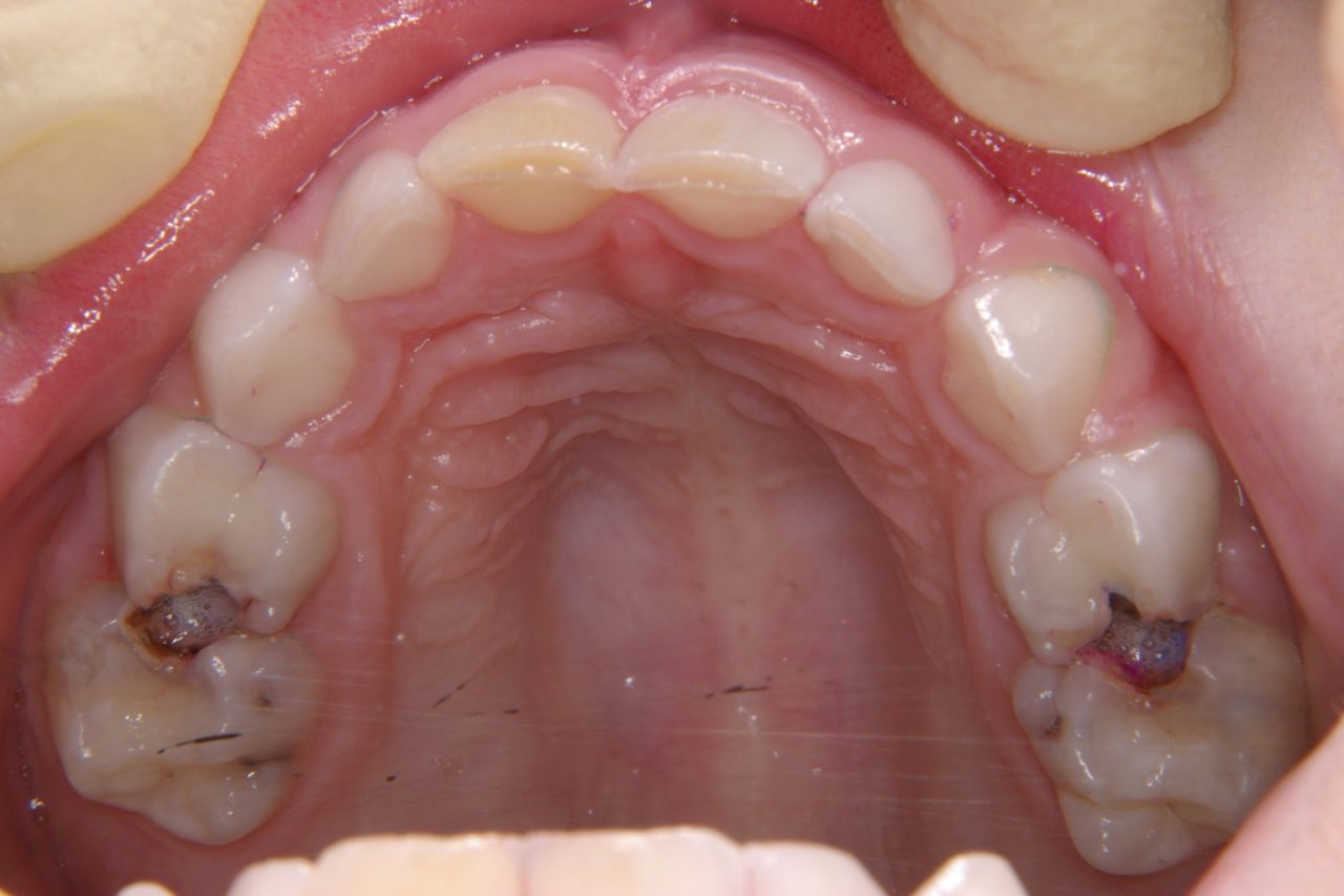 Chuyên gia giải đáp: Sâu răng có lây không? | TCI Hospital