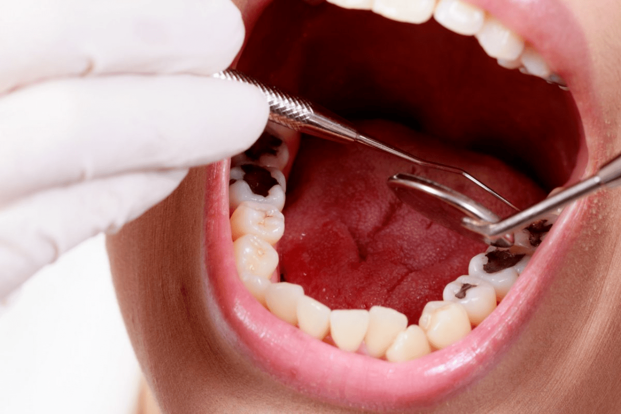 Những biểu hiện như thế nào cho thấy răng sâu cần được nhổ ngay?
