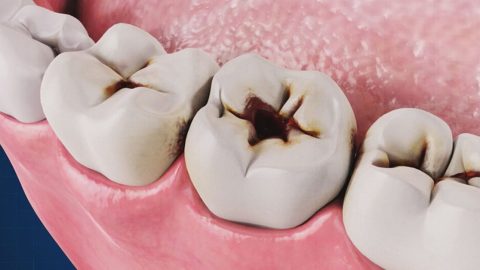 Sâu răng lâu năm có ảnh hưởng gì không?