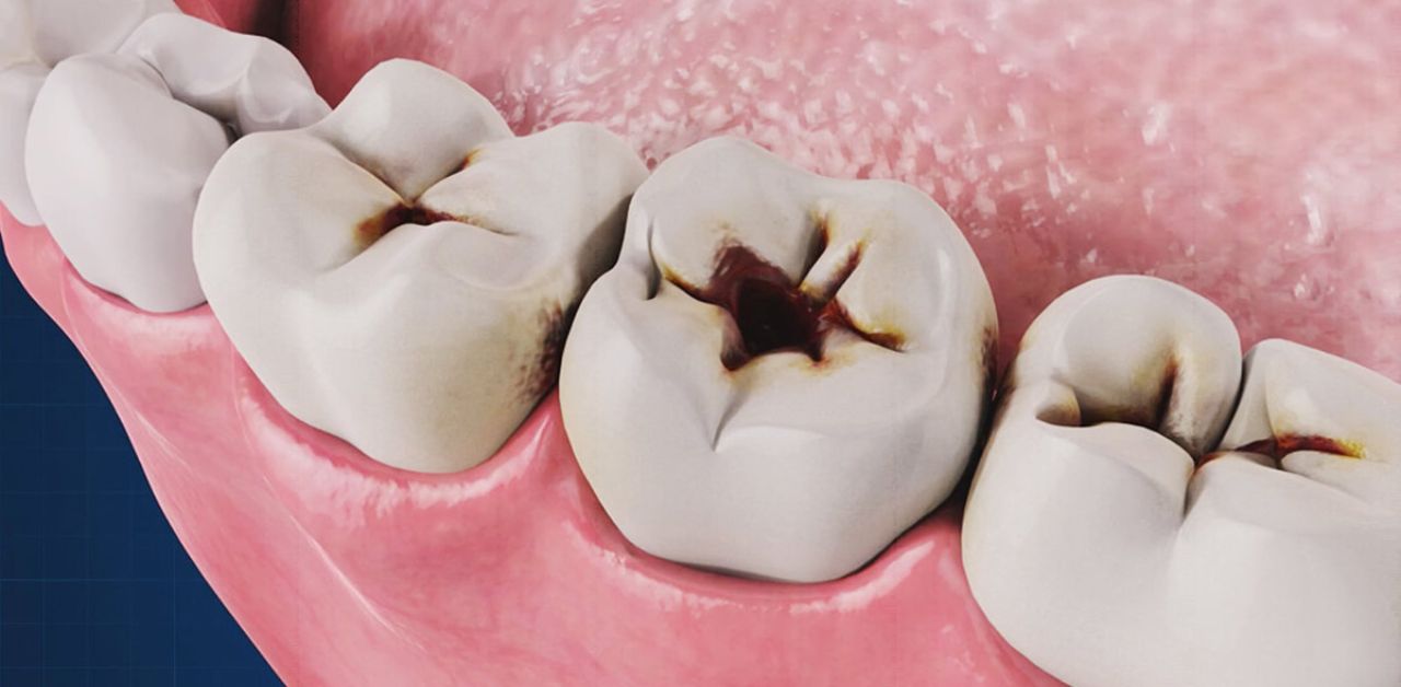 Những biểu hiện và triệu chứng của sâu răng để lâu?
