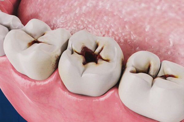 Sâu răng là tình trạng vi khuẩn phát triển quá mức, tấn công các mô răng, khiến răng bị suy yếu dần