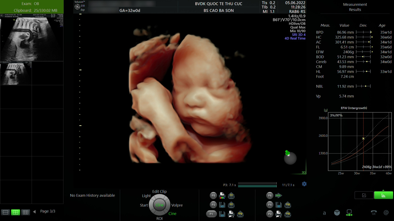 Siêu âm thai 5D là phương pháp siêu âm hiện đại nhất, cho hình ảnh thai nhi sắc nét, chân thực, đồng thời giúp phát hiện sớm dị tật thai nhi