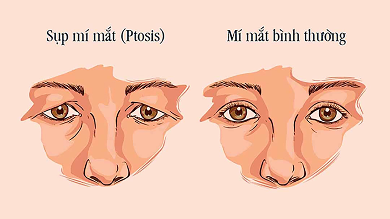 Những triệu chứng thường gặp khi sụp mí mắt?
