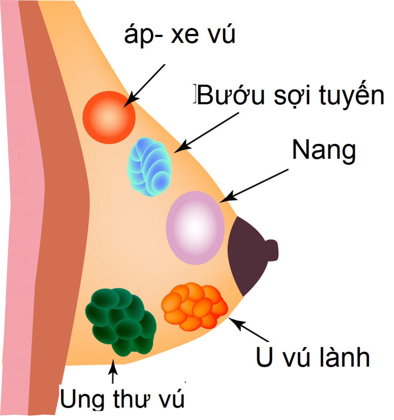 Hiện tượng tắc tia sữa gây áp xe cần phải điều trị ra sao? | TCI ...