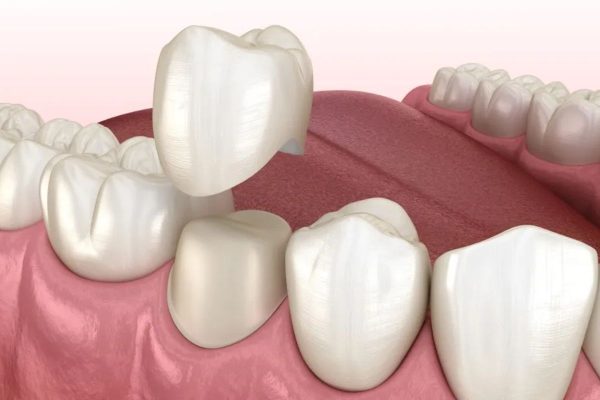 Mão sứ được gắn trực tiếp lên răng thật thông qua một lớp keo dán đặc biệt
