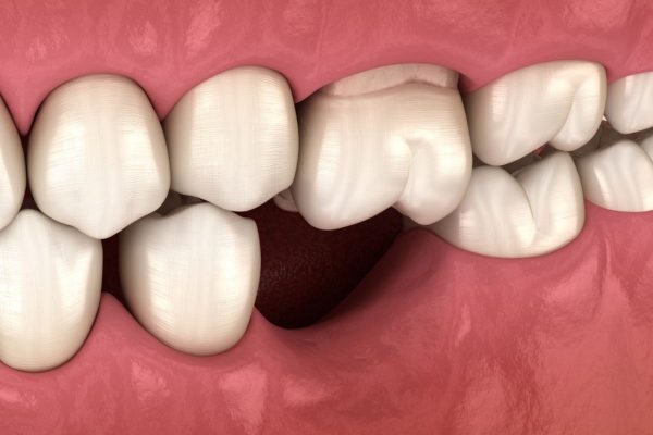 Mất răng làm giảm lực ăn nhai và có thể gây xô lệch các răng khác, nguy cơ mắc bệnh lý cũng cao hơn