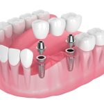 Tại sao phải cấy ghép Implant cho răng bị mất?