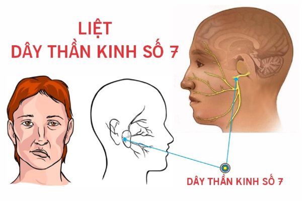 Dây thần kinh số 7 nằm ở đâu?bệnh về tim mạch, chấn thương