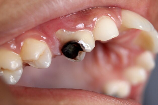 trị sâu răng trước khi răng xuất hiện lỗ sâu