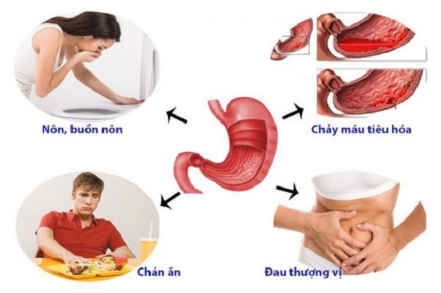 Triệu chứng của loét dạ dày khá đa dạng
