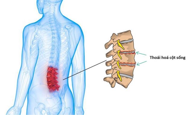 Thoái hóa cột sống lưng là tình trạng đĩa đệm và sụn khớp ở các đốt sống thắt lưng bị tổn thương