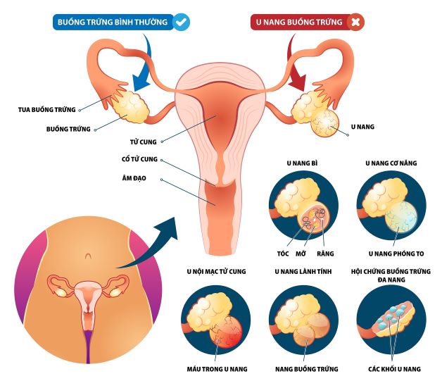 Hình ảnh phân biệt buồng trứng bình thường và u nang buồng trứng