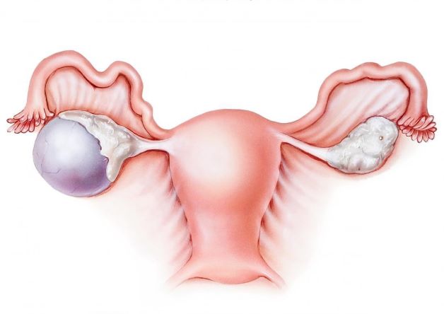 Hình ảnh so sánh giữa buồng trứng bình thường và buồng trứng bị u nang cơ năng