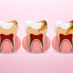 Tất tần tật về vi khuẩn gây sâu răng bạn nhất định phải biết