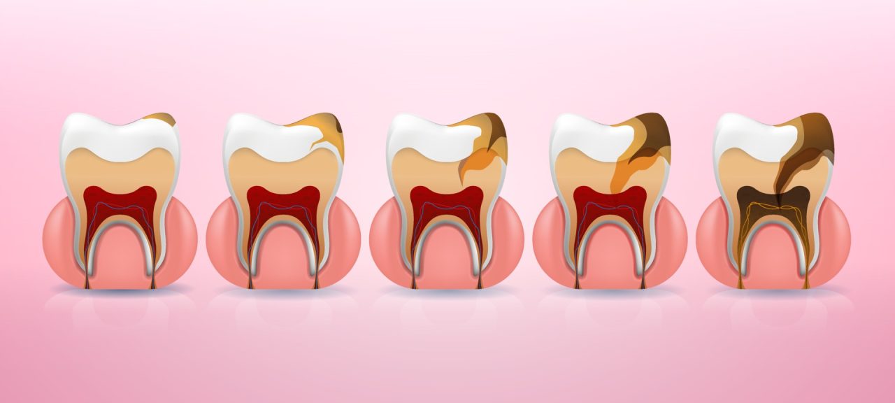 Vi khuẩn sâu răng phát triển trong mảng bám như thế nào?
