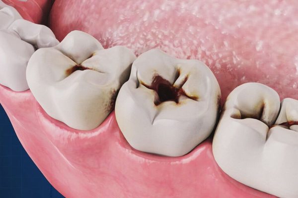 Sâu răng là tình trạng tổn thương mô cứng của răng, do vi khuẩn tích tụ trên bề mặt răng gây ra