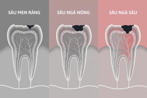 3 mức độ sâu răng cơ bản, ảnh hưởng lớn tới sức khỏe răng miệng của mọi người