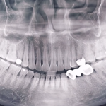 Điều trị tủy, làm trục sứ cho khách hàng bị sâu răng hỏng tủy