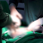 Phẫu thuật bóc u nang buồng trứng cho bệnh nhân 18 tuổi
