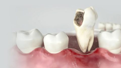Bọc răng sứ bị viêm lợi: Nguyên nhân và cách điều trị