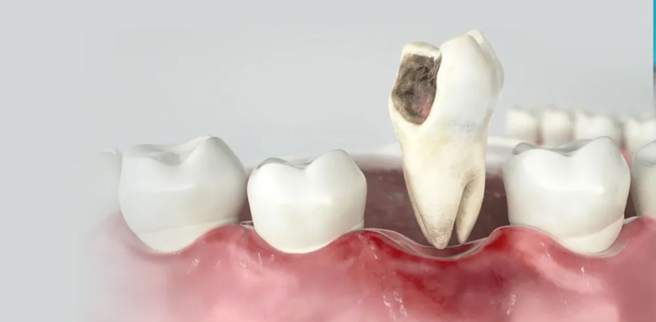  Bọc răng sứ bị viêm lợi - Nguyên nhân và cách điều trị hiệu quả