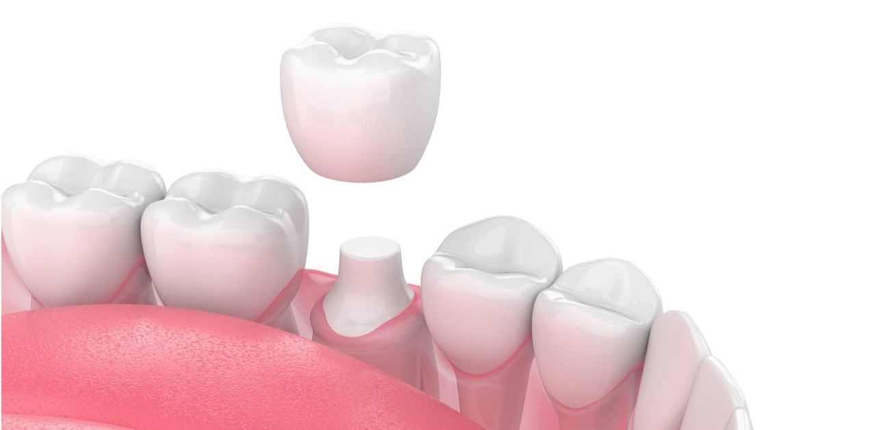  Bọc răng sứ mài ít : Những điều bạn cần biết