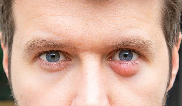 cách chữa lẹo mắt