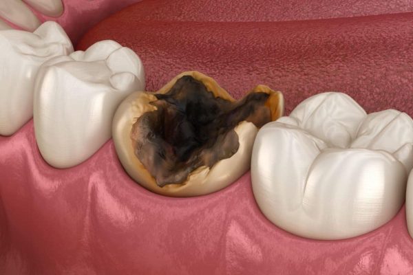 Tổ chức răng hàm bị tổn thương do sự tấn công của vi khuẩn gây sâu răng
