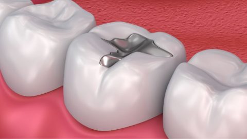 Cách chữa răng hàm bị sâu dứt điểm
