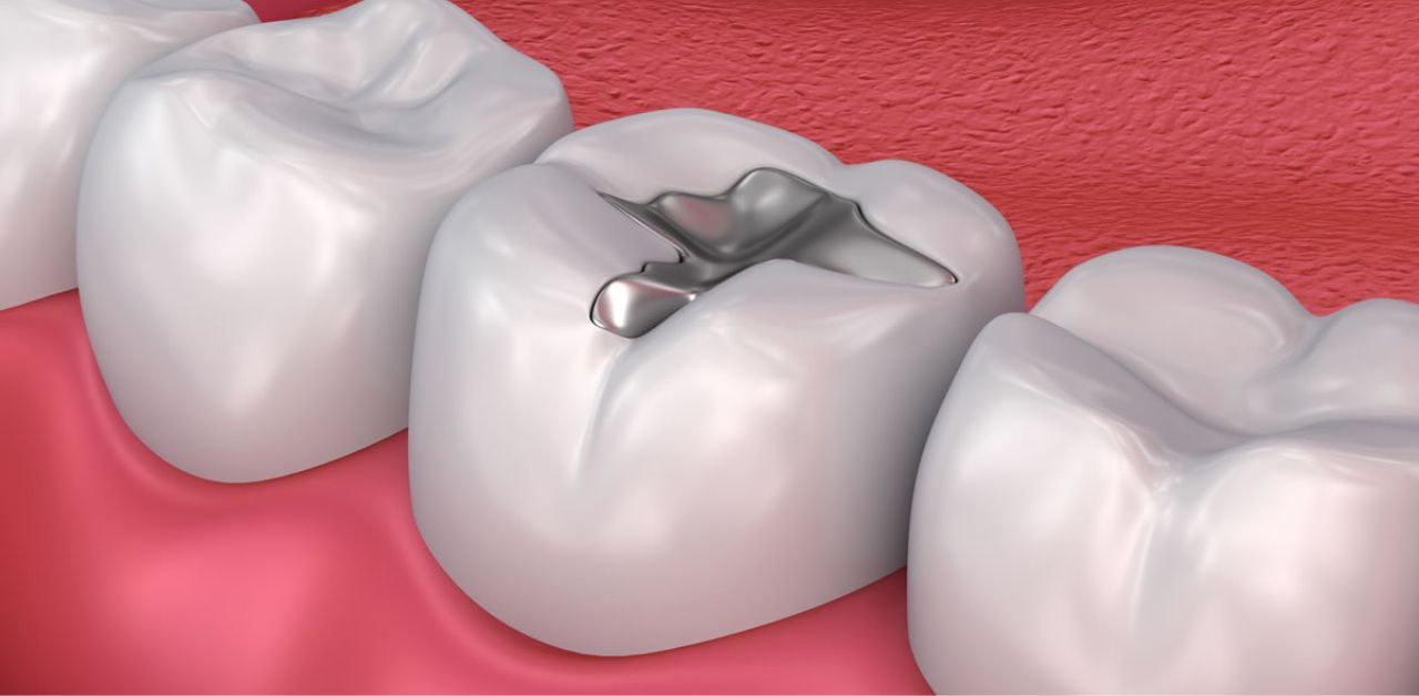 Lớp men răng bị phá hủy trong trường hợp nào khi răng hàm bị sâu đen?

