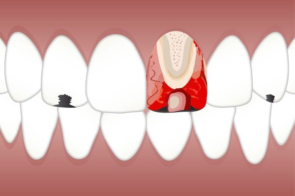 Sâu răng gây ra biến chứng viêm tủy răng, mất răng, nhiễm trùng huyết... ảnh hưởng lớn tới sức khỏe và tính mạng của mọi người