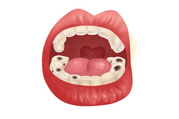 Tình trạng tổn thương men răng, ngà răng hình thành các chấm đen trên bề mặt răng do vi khuẩn gây ra gọi là sâu răng