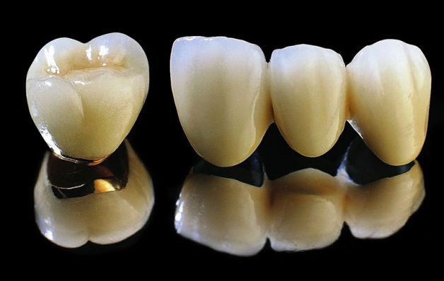 Có bao nhiêu loại răng sứ đảm bảo công năng xử lý thức ăn? Cả 4 loại đều đảm bảo