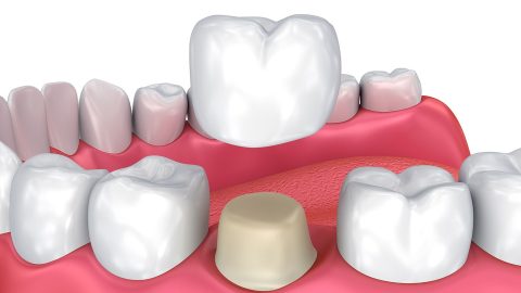 Chuyên gia giải đáp: Có bao nhiêu loại răng sứ?