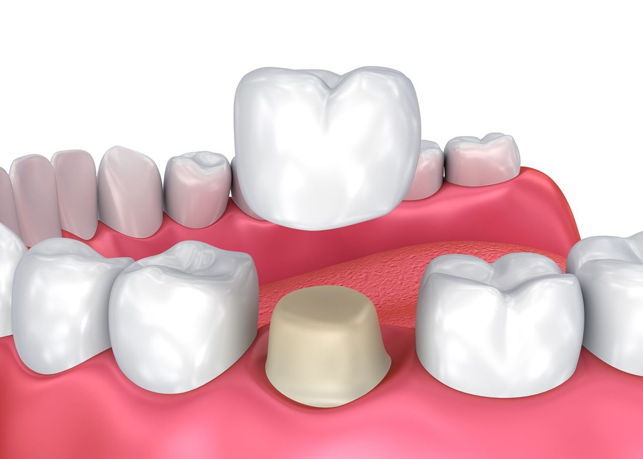 Giá cả và thời gian sử dụng của răng toàn sứ Cercon là bao nhiêu?