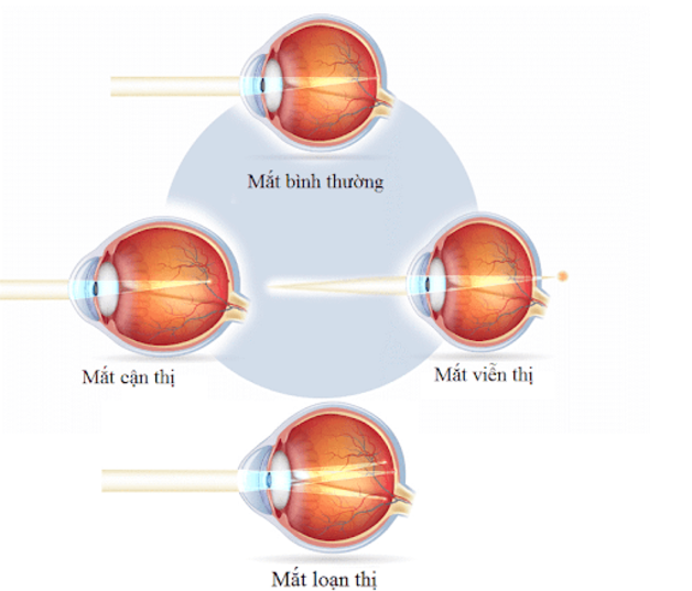 3. Các phương pháp điều trị tật khúc xạ hiện nay