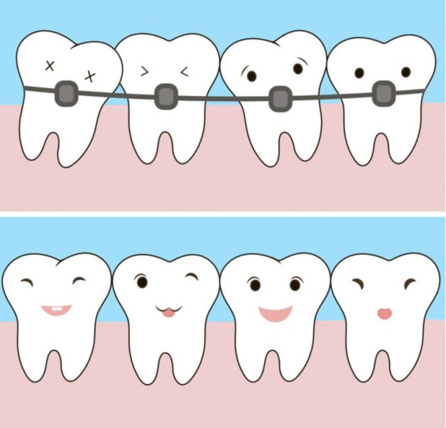 Chỉnh nha giúp răng dịch chuyển, từ đó giúp giảm khoảng cách từ cổ răng đến môi và giảm biểu hiện của cười hở lợi