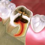 Cuống răng nằm ở đâu? Tại sao bị viêm cuống răng?