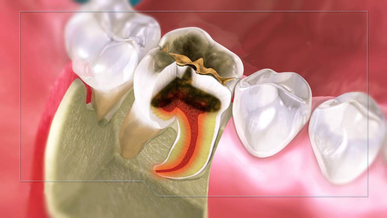 Nguyên nhân gây ra viêm quanh cuống răng là gì?
