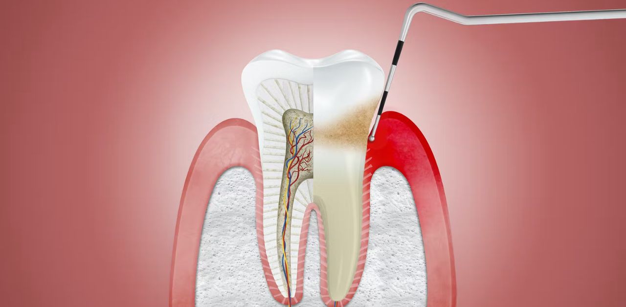 Cách phòng ngừa viêm lợi hiệu quả là gì?
