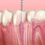 Quá trình điều trị tủy răng có lâu không?
