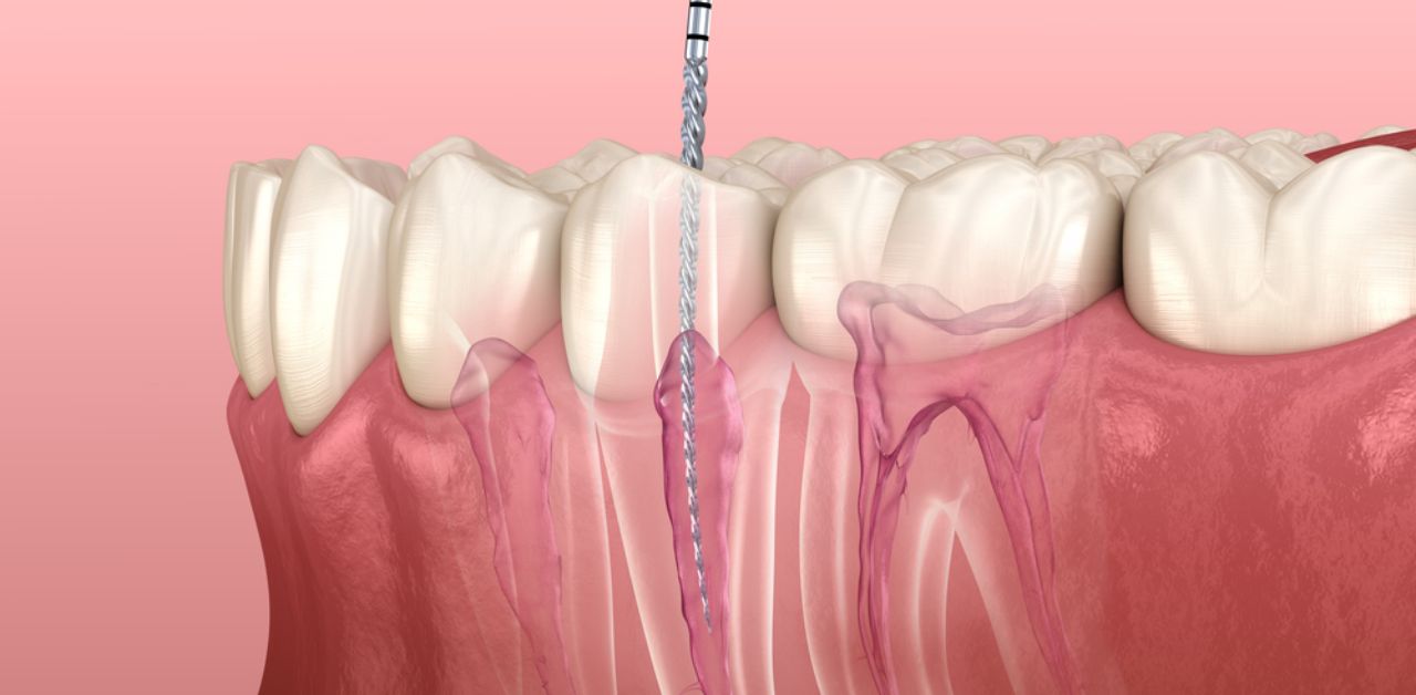 Có những tác dụng phụ nào khi sử dụng thuốc điều trị tủy răng?
