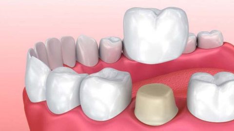 Giải đáp: Điều trị tủy răng có nên bọc sứ không?