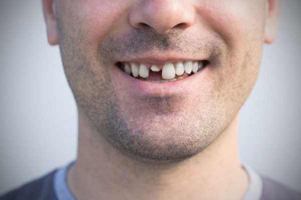 Răng gãy vỡ, chấn thương bị viêm tủy nếu không điều trị kịp thời có thể dẫn tới mất răng